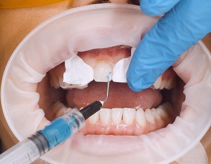 Dental Bondings