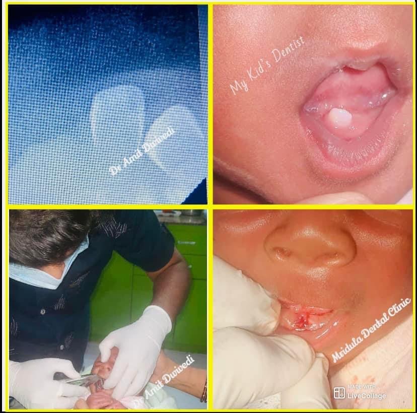 Braces & Aligners